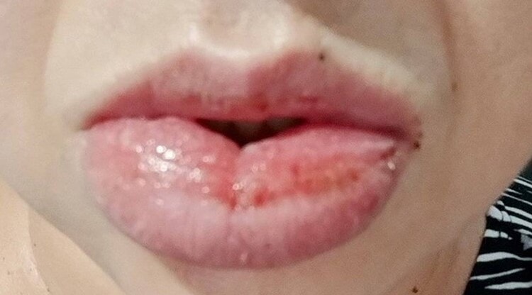 TROUT POUT - Nothing To Smile About Over Toothpaste Allergy - Article cover image