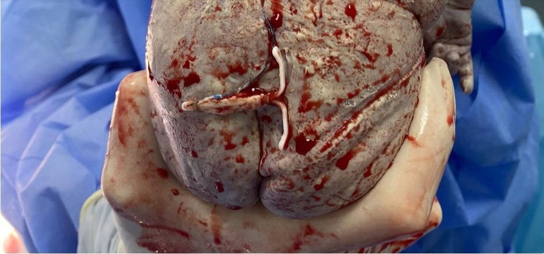 BOY OR A COIL? Baby Born With Mum's IUD Stuck To His Butt - Article cover image