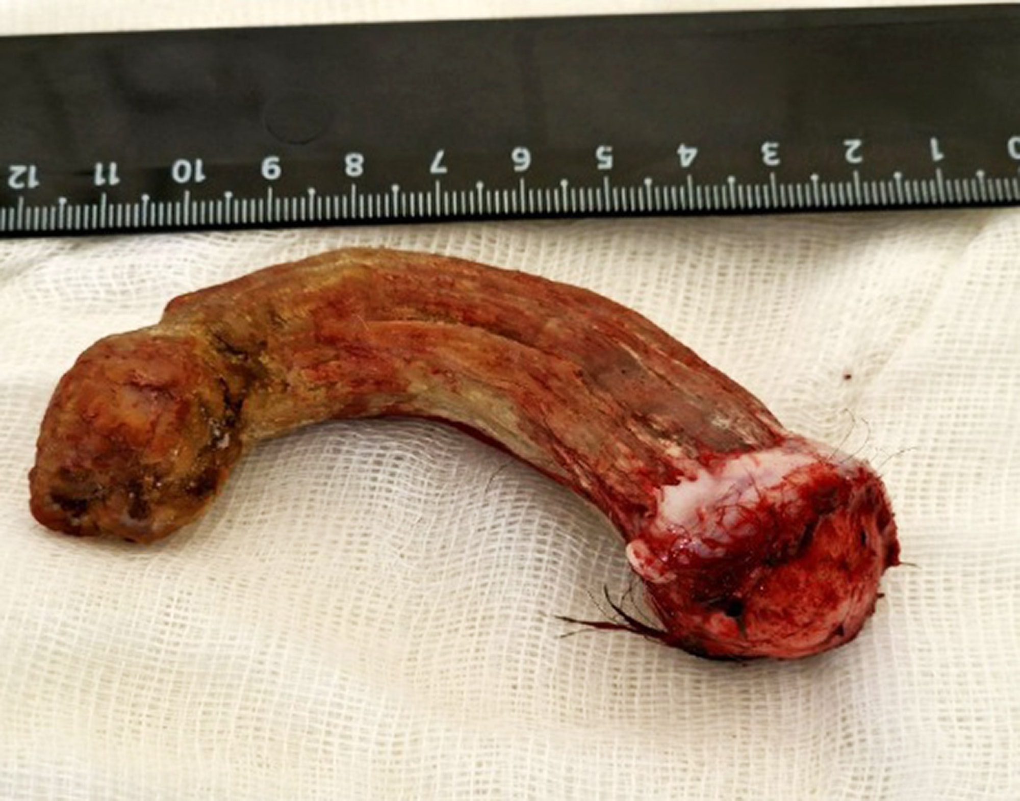 HELL OF AN OP - Surgeons Remove Giant Devil's Horn Growth From Man's Head - Article cover image