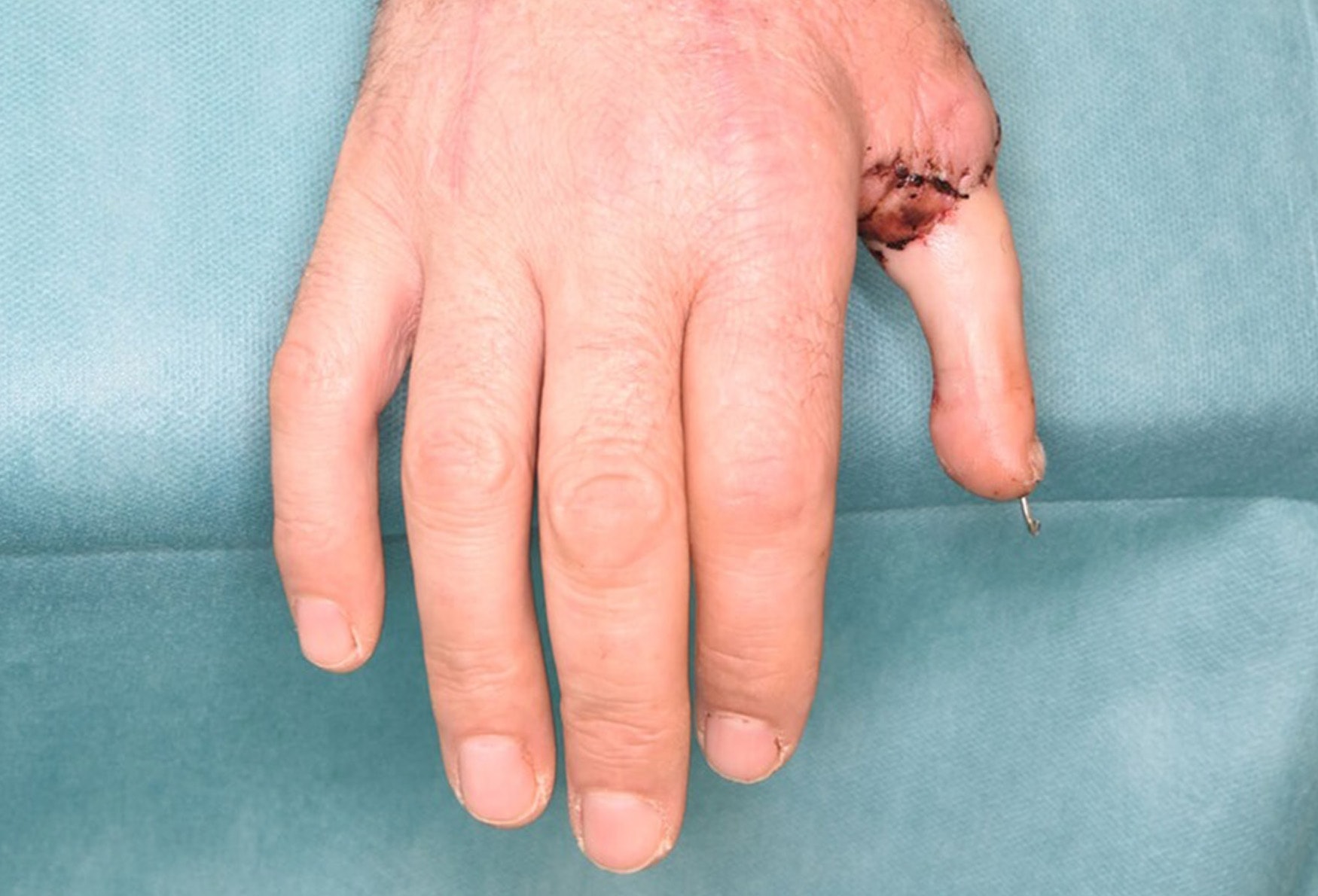 TOE VERY MUCH - Farmer Gives Surgeons Thumbs Up For New Digit - Article cover image