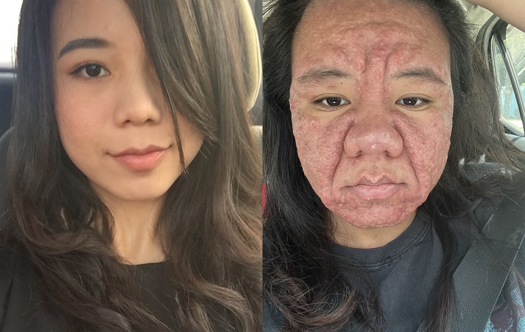 MOTHERHOOD - Face Transformed By Pregnancy Acne But Woman Says She's Grateful - Article cover image
