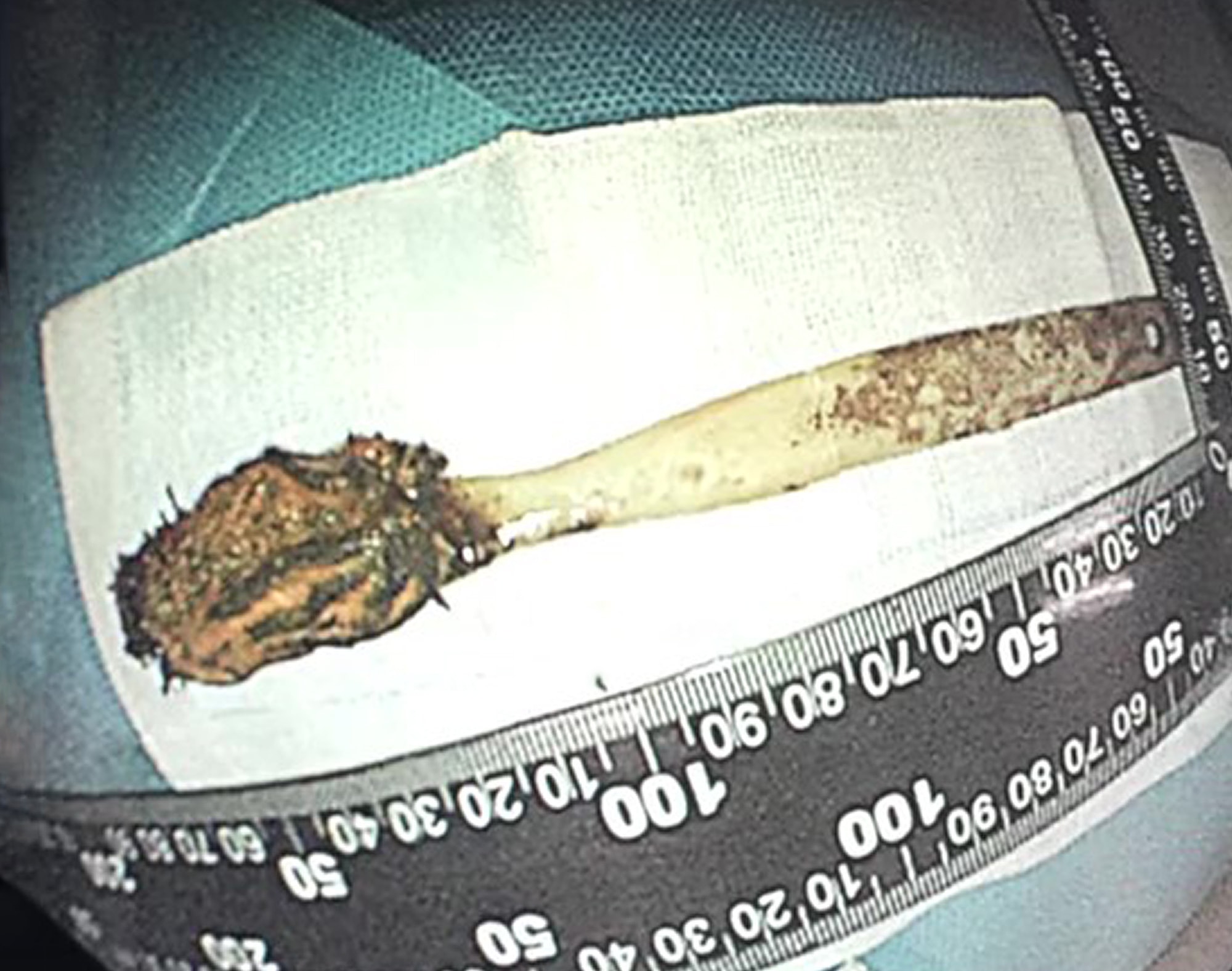 BRUSH WITH DEATH - Patient With Agonising Chest Pains Had Swallowed Toothbrush 52 Years Ago - Article cover image