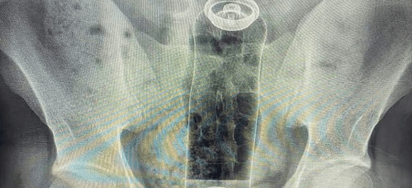 Astonished Medics Remove Deodorant Can From Teenage Boy's Rectum - Article cover image