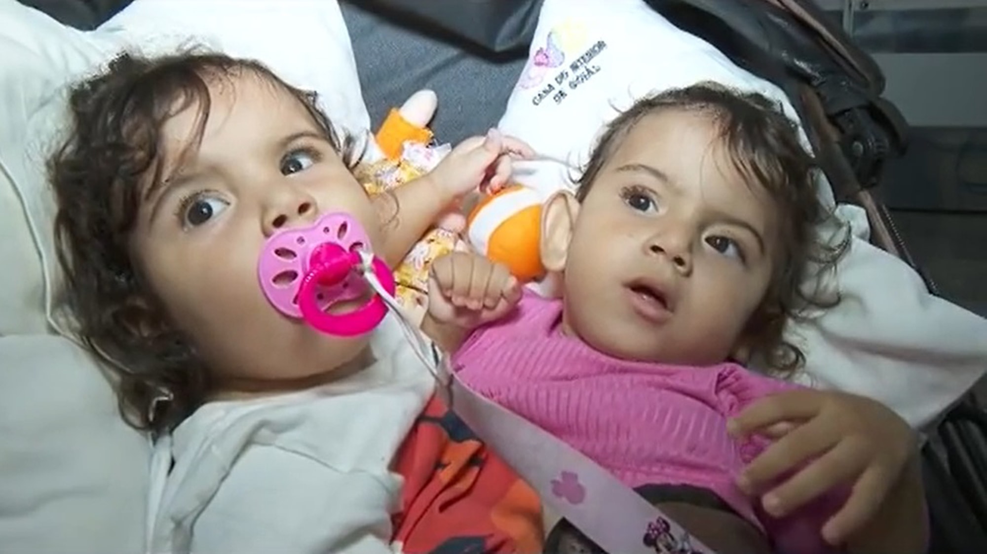 TWINCREDIBLE! Conjoined Twins Separated In 15-Hour Op - Article cover image